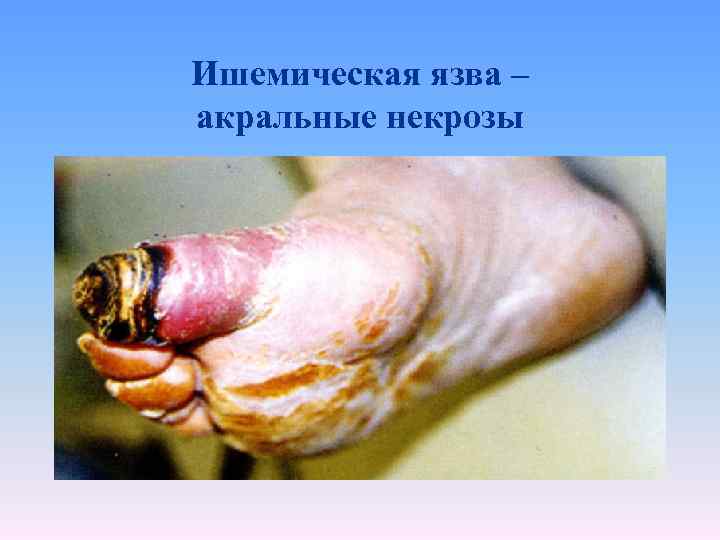 Ишемическая язва – акральные некрозы 