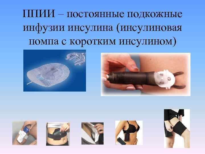 ППИИ – постоянные подкожные инфузии инсулина (инсулиновая помпа с коротким инсулином) 