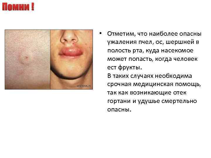 Помни ! • Отметим, что наиболее опасны ужаления пчел, ос, шершней в полость рта,