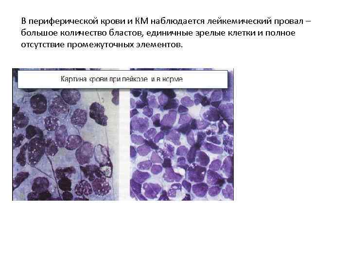 В периферической крови и КМ наблюдается лейкемический провал – большое количество бластов, единичные зрелые