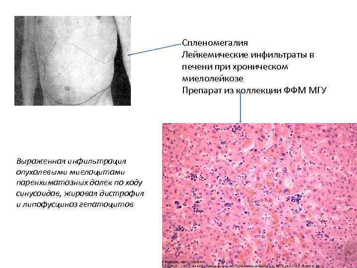 Спленомегалия Лейкемические инфильтраты в печени при хроническом миелолейкозе Препарат из коллекции ФФМ МГУ Выраженная