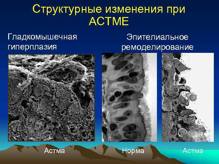Структурные изменения при АСТМЕ Гладкомышечная гиперплазия Астма Эпителиальное ремоделирование Норма Астма 