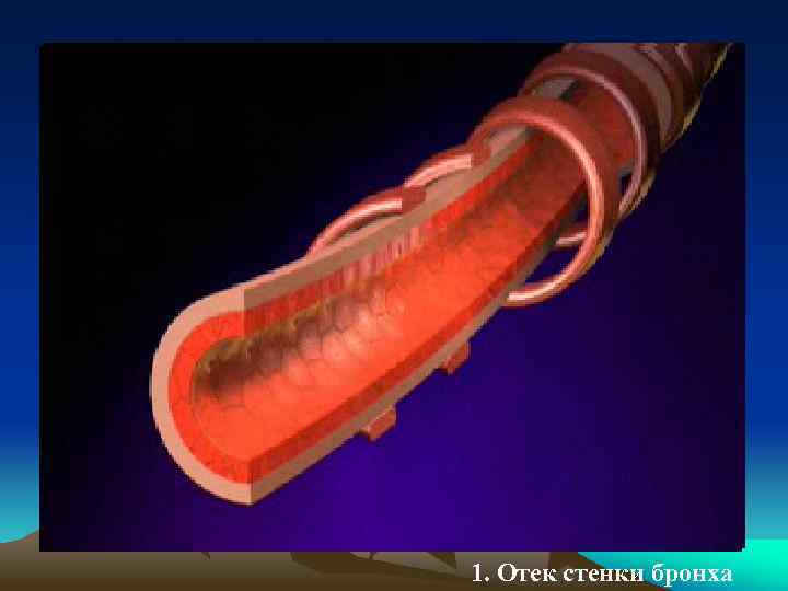 1. Отек стенки бронха 