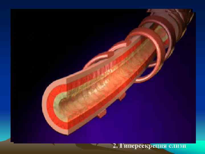 2. Гиперсекреция слизи 