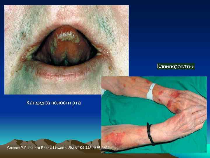 Капиляропатии Кандидоз полости рта Graeme P Currie and Brian J Lipworth. BMJ 2006; 332;