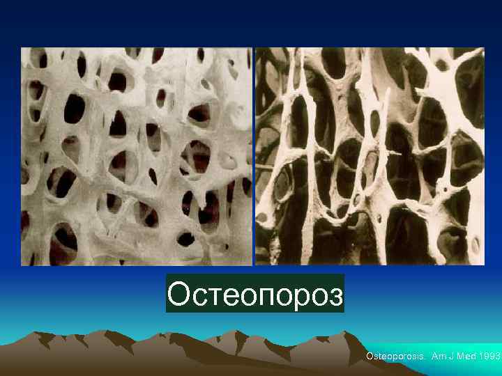 Остеопороз Osteoporosis. Am J Med 1993 