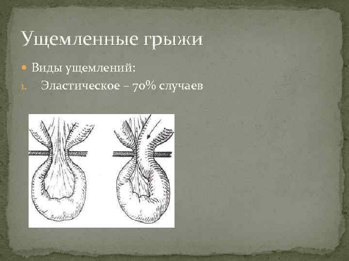 Ущемленные грыжи Виды ущемлений: 1. Эластическое – 70% случаев 