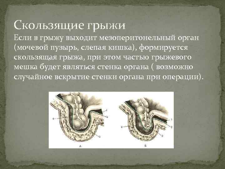 Скользящие грыжи Если в грыжу выходит мезоперитонельный орган (мочевой пузырь, слепая кишка), формируется скользящая