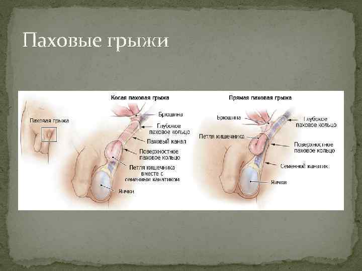 Паховые грыжи 