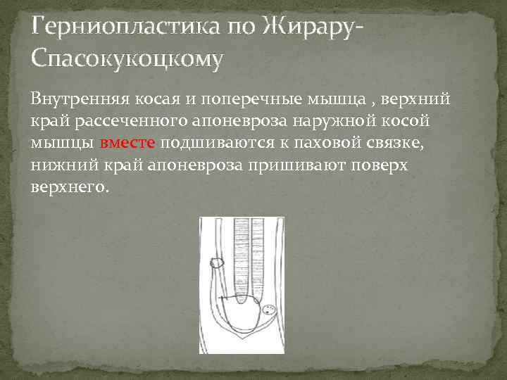 Герниопластика по Жирару. Спасокукоцкому Внутренняя косая и поперечные мышца , верхний край рассеченного апоневроза