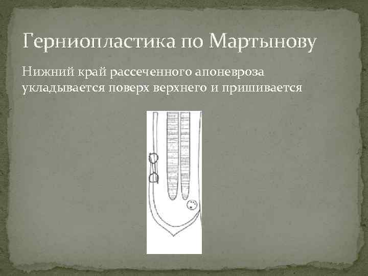 Герниопластика по Мартынову Нижний край рассеченного апоневроза укладывается поверхнего и пришивается 