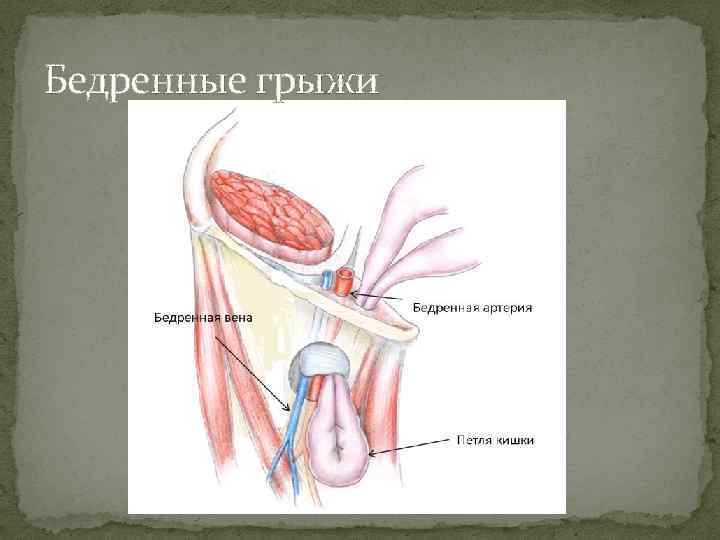 Бедренные грыжи 