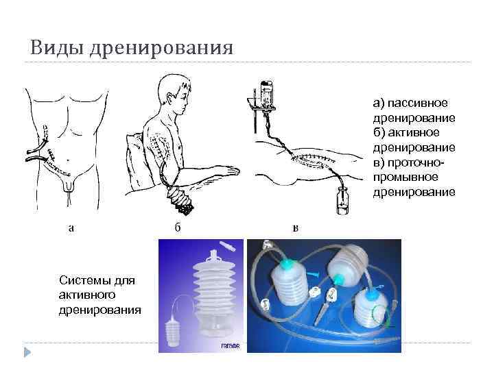 Виды дренирования а) пассивное дренирование б) активное дренирование в) проточнопромывное дренирование Системы для активного