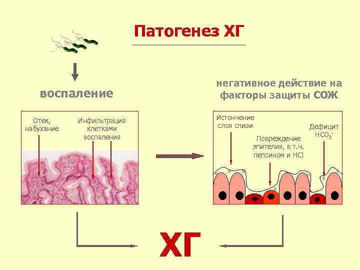 Патогенез ХГ негативное действие на факторы защиты СОЖ воспаление Отек, набухание Истончение слоя слизи