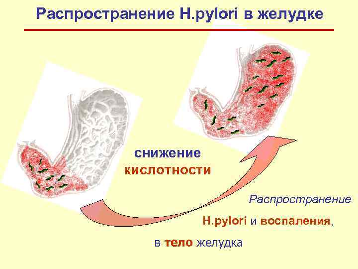 Распространение Н. pylori в желудке снижение кислотности Распространение Н. pylori и воспаления, в тело