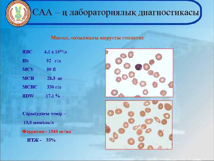 САА – ң лабораториялық диагностикасы Мысал, созылмалы вирусты геппатит RBC 4. 1 x 1012/л