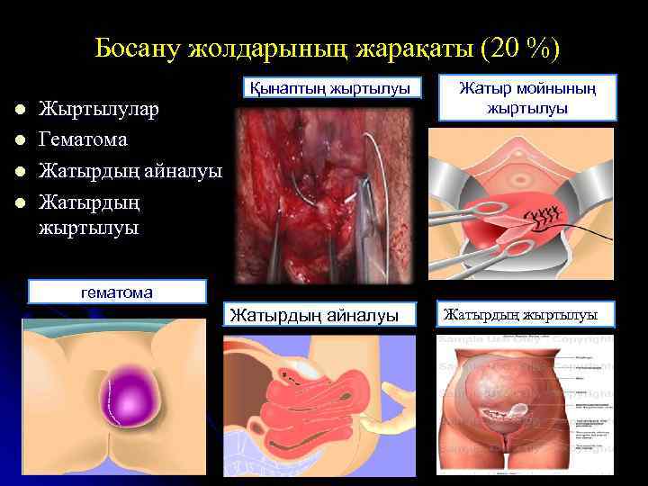 Босану жолдарының жарақаты (20 %) l l Жыртылулар Гематома Жатырдың айналуы Жатырдың жыртылуы Қынаптың