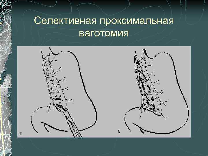 Селективная проксимальная ваготомия 