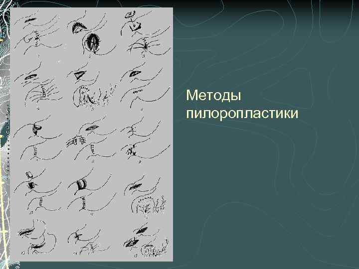 Методы пилоропластики 