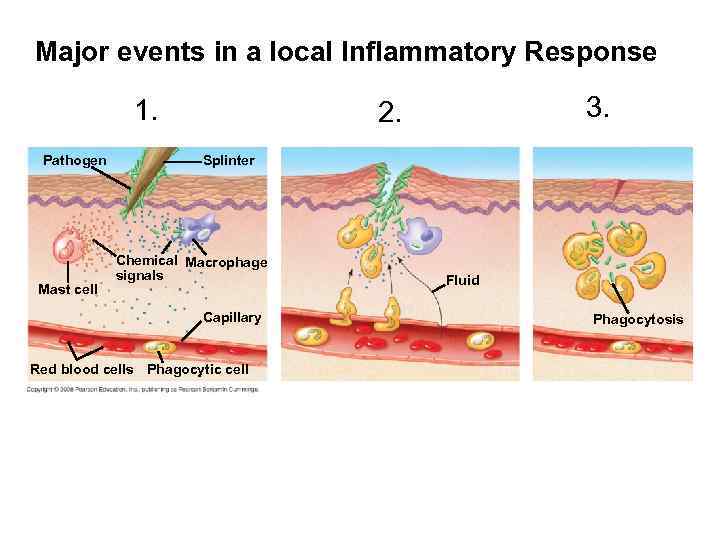 Major events in a local Inflammatory Response 1. Pathogen Mast cell 3. 2. Splinter