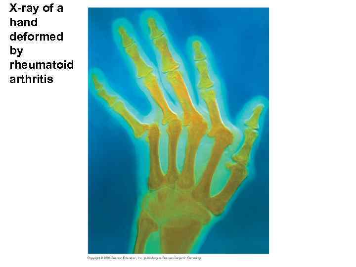 X-ray of a hand deformed by rheumatoid arthritis 