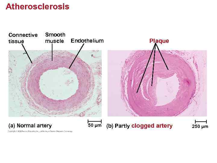 Atherosclerosis Connective tissue Smooth muscle (a) Normal artery Endothelium 50 µm (b) Partly Plaque