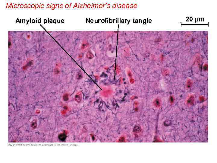 Microscopic signs of Alzheimer’s disease Amyloid plaque Neurofibrillary tangle 20 µm 