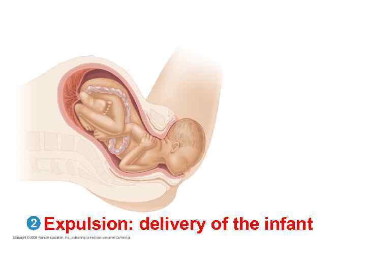 2 Expulsion: delivery of the infant 