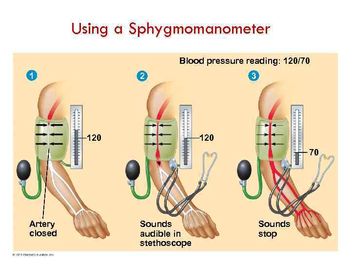 Using a Sphygmomanometer Blood pressure reading: 120/70 1 3 2 120 70 Artery closed