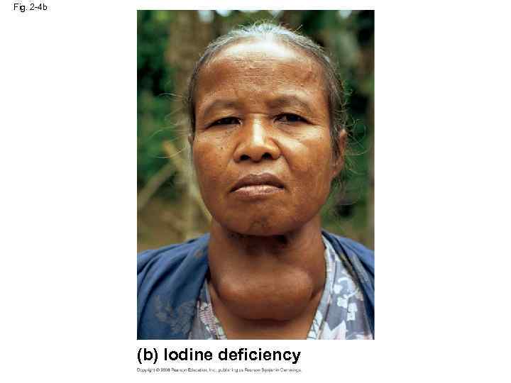 Fig. 2 -4 b (b) Iodine deficiency 