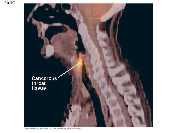 Fig. 2 -7 Cancerous throat tissue 