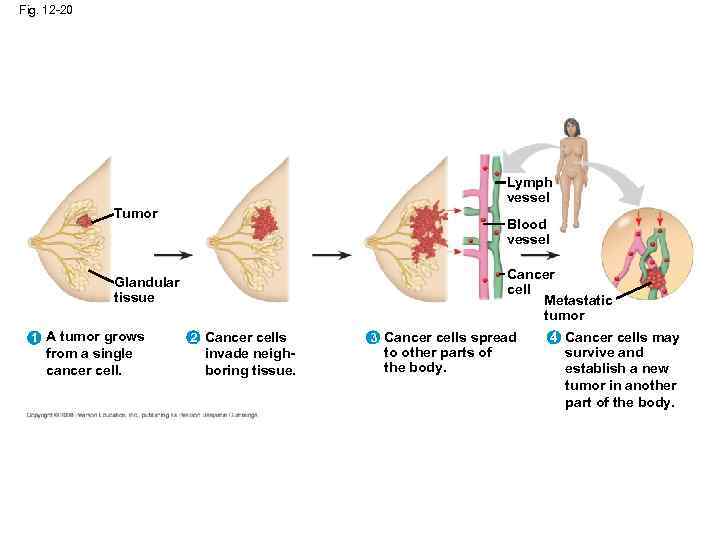 Fig. 12 -20 Lymph vessel Tumor Blood vessel Cancer cell Metastatic tumor Glandular tissue