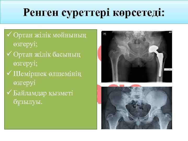 Ренген суреттері көрсетеді: ü Ортан жілік мойнының өзгеруі; ü Ортан жілік басының өзгеруі; ü