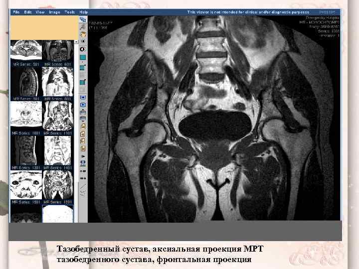 Тазобедренный сустав, аксиальная проекция МРТ тазобедренного сустава, фронтальная проекция 