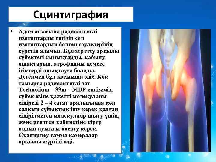 Сцинтиграфия • Адам ағзасына радиоактивті изотоптарды енгізіп сол изотоптардың бөлген сәулелерінің суретін аламыз. Бұл