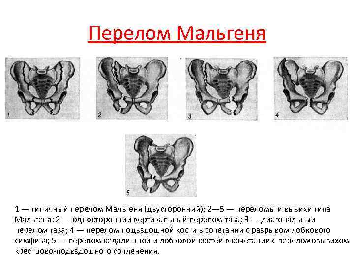 Переломы таза у детей презентация