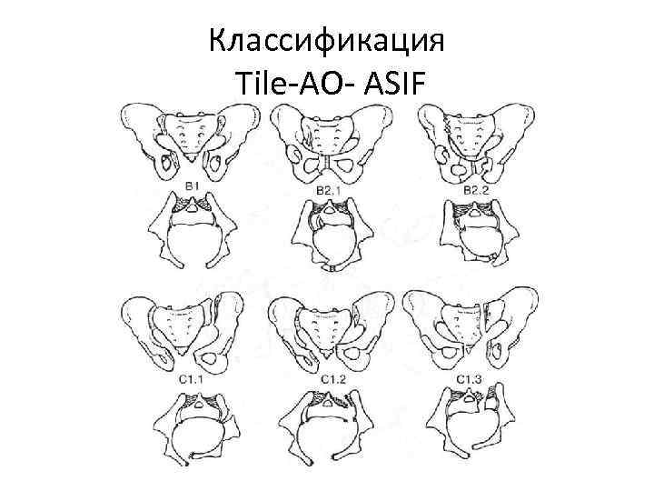 Классификация Tile-AO- ASIF 