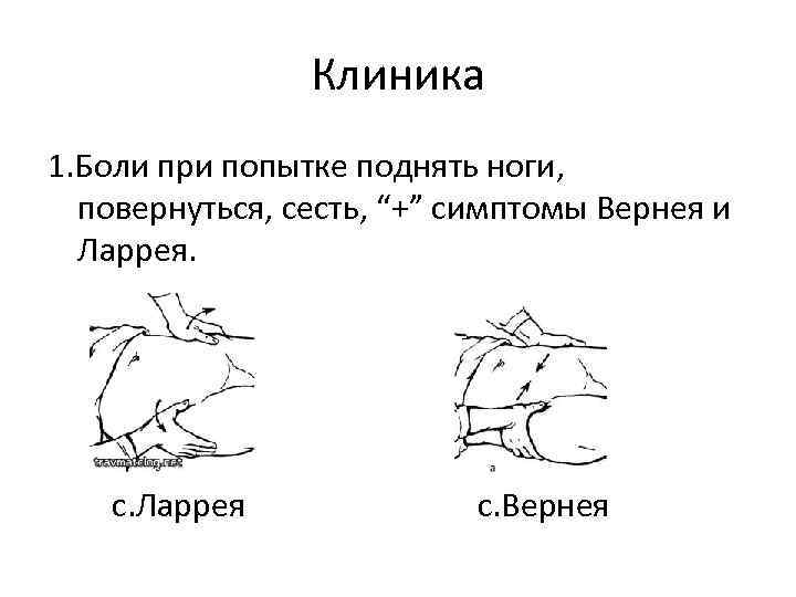 Клиника 1. Боли при попытке поднять ноги, повернуться, сесть, “+” симптомы Вернея и Ларрея.