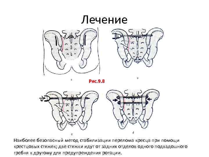 Лечение Наиболее безопасный метод стабилизации перелома кресца при помощи крестцовых стяжек; две стяжки идут