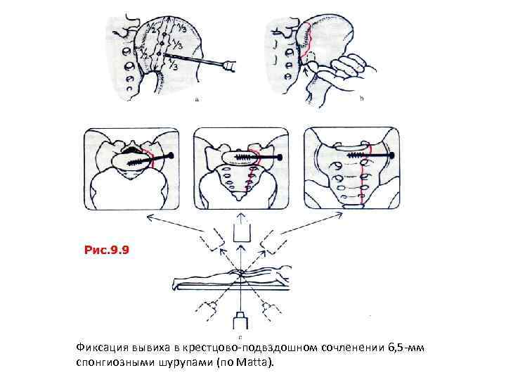 Фиксация вывиха в крестцово-подвздошном сочленении 6, 5 -мм спонгиозными шурупами (по Matta). 