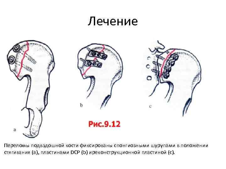 Перелом костей таза карта вызова смп