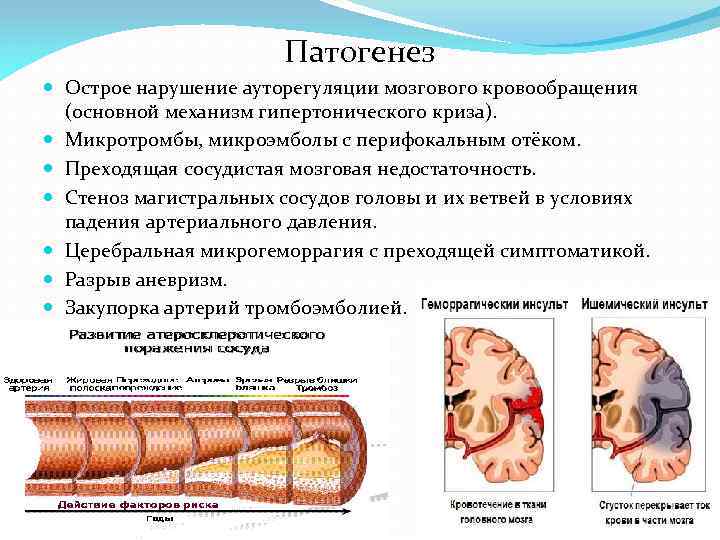 Патогенез Острое нарушение ауторегуляции мозгового кровообращения (основной механизм гипертонического криза). Микротромбы, микроэмболы с перифокальным