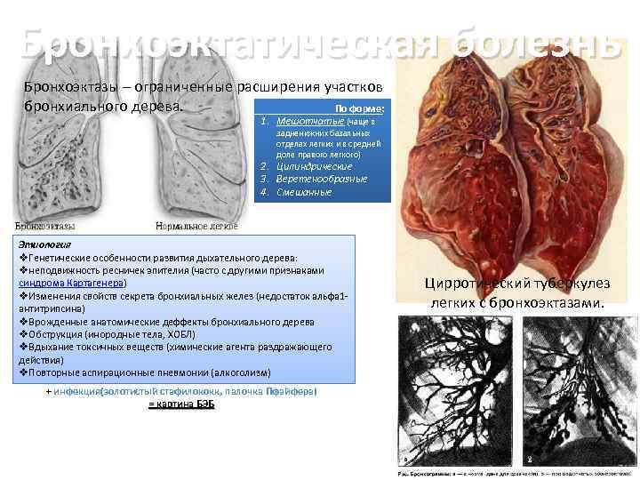 Бронхоэктатическая болезнь Бронхоэктазы – ограниченные расширения участков бронхиального дерева. По форме: 1. Мешотчатые (чаще