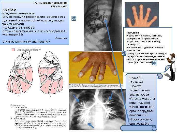 Клинические проявления Обострение -Лихорадка -Ухудшение самочувствия -Усиление кашля + резкое увеличение количества отделяемой слизисто-гнойной