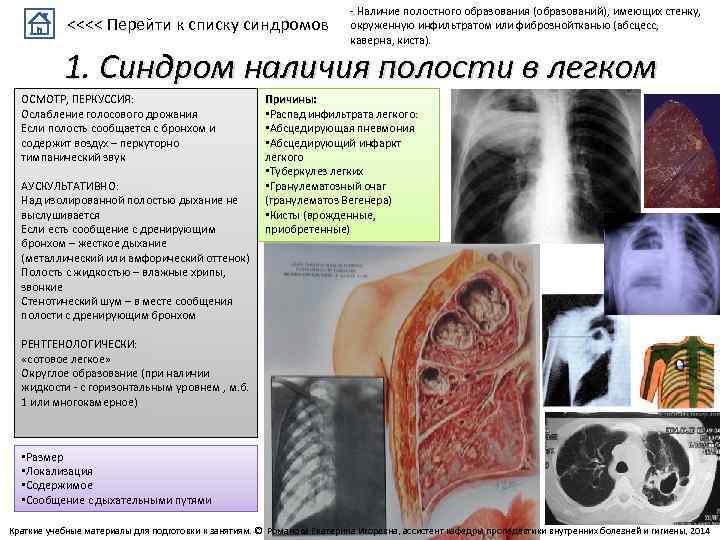 <<<< Перейти к списку синдромов - Наличие полостного образования (образований), имеющих стенку, окруженную инфильтратом
