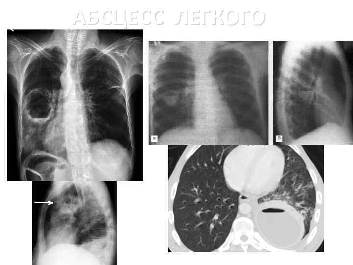 Абсцесс легкого фото