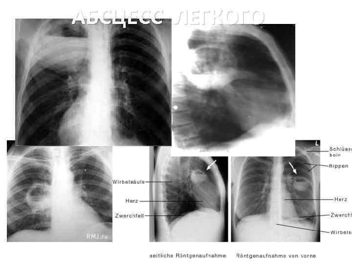 АБСЦЕСС ЛЕГКОГО 