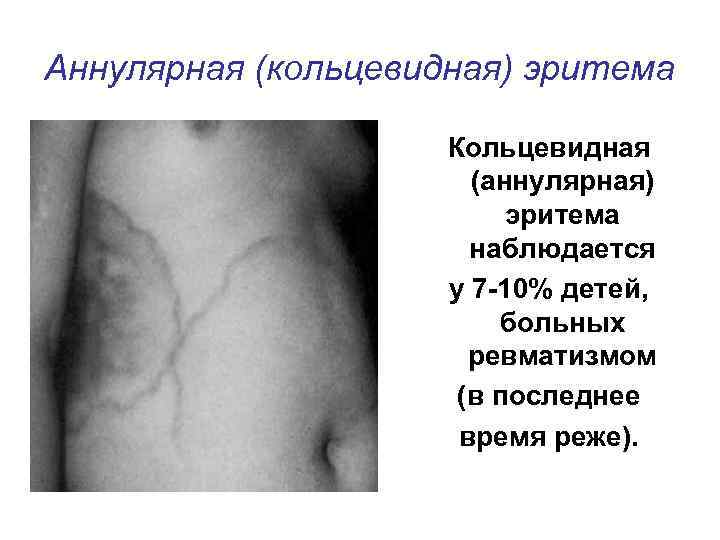 Аннулярная (кольцевидная) эритема Кольцевидная (аннулярная) эритема наблюдается у 7 -10% детей, больных ревматизмом (в