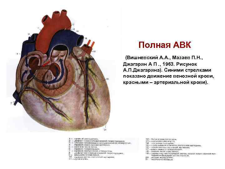 Открытый атриовентрикулярный канал презентация