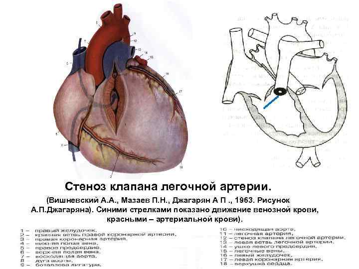 Клапан легочной артерии створки